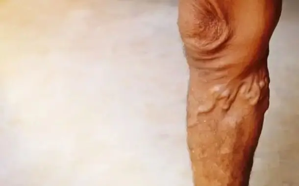 Vascular Conditions
